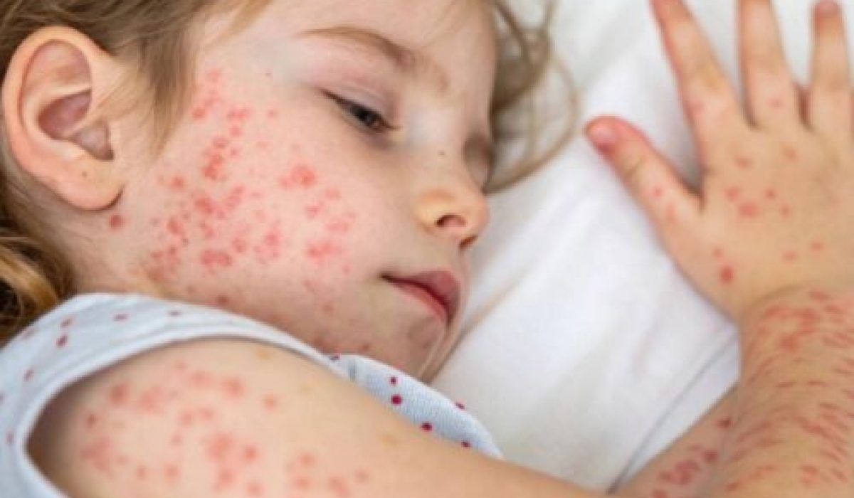 697d4fcbb576fc317ba4cabb_measles-kid